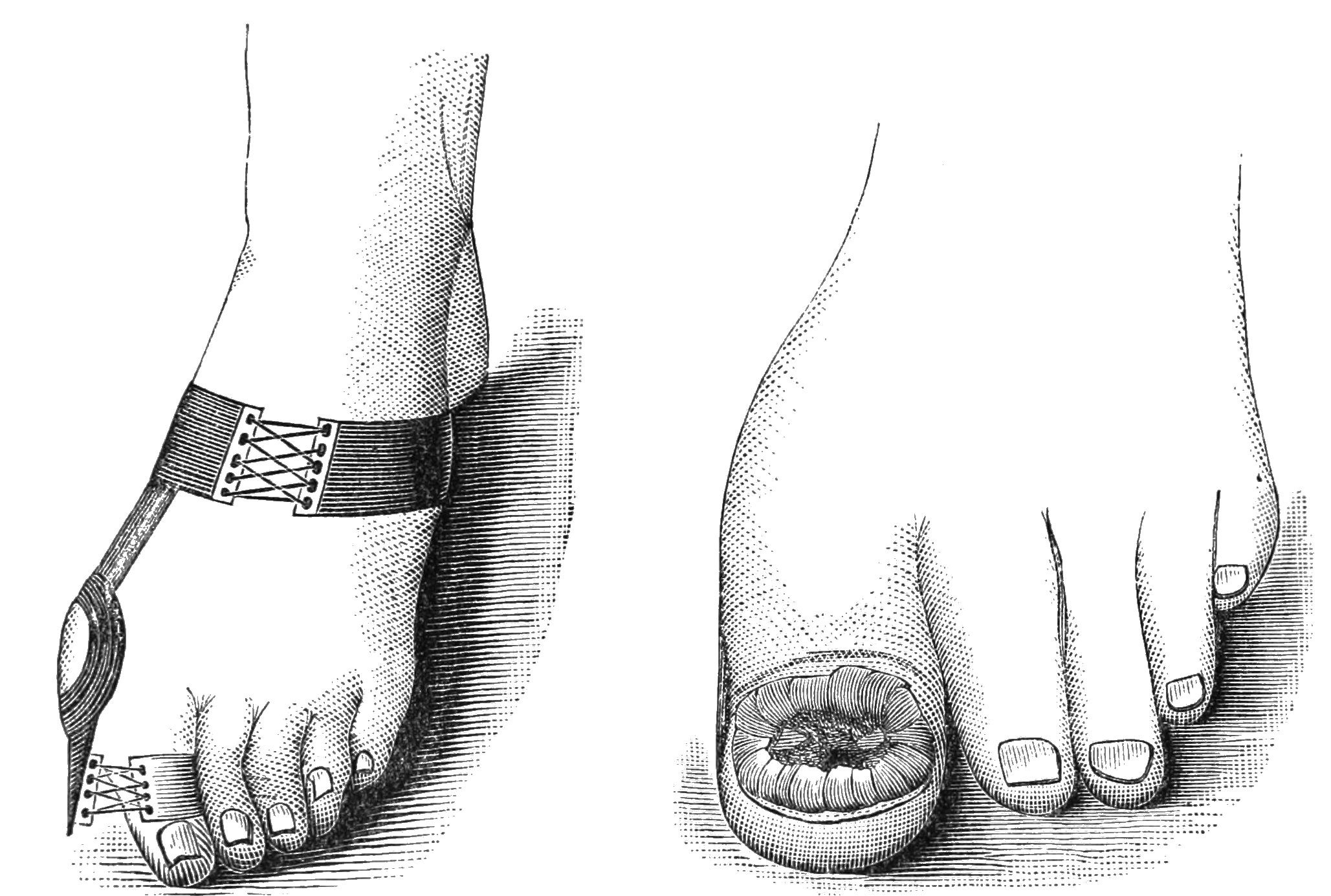 Schwarzer und wei├čer Zeichnung von zwei Fü├čen, eine mit einem Verband und die andere mit einer Fraktur, mit Text, der den Verband als Behandlung anzeigt.