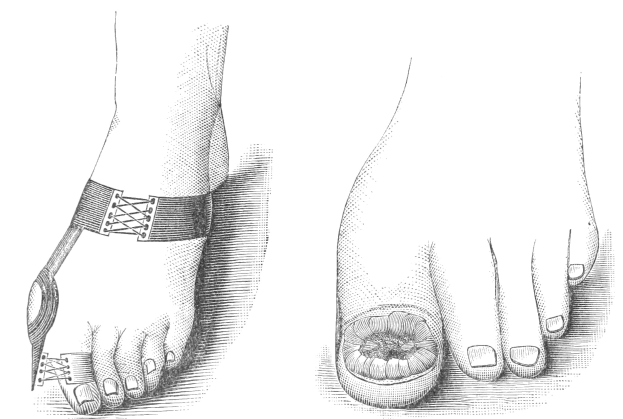 Schwarzer und wei├čer Zeichnung von zwei Fü├čen, eine mit einem Verband und die andere mit einer Fraktur, mit Text, der den Verband als Behandlung anzeigt.